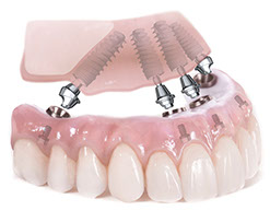 Implants available at Donatt Dental