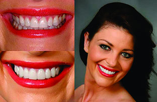 Donatt Dental Patient before and after
