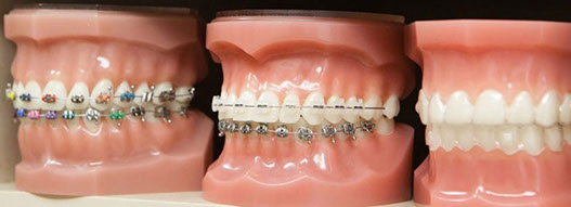 Braces or brackets at Donatt Dental